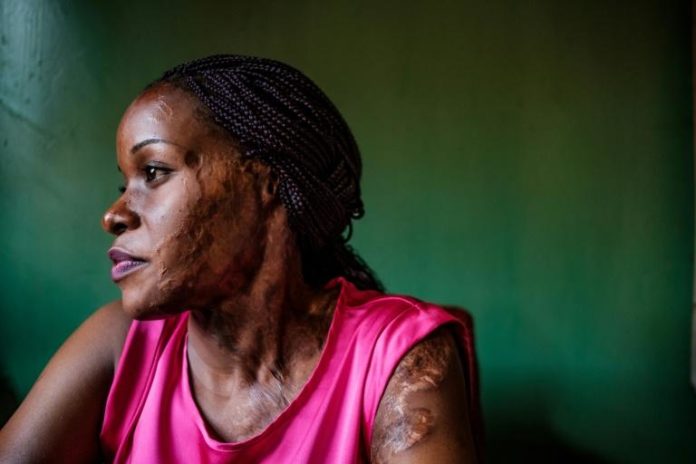 Linette Kirungi, victime d'une attaque à l'acide, photographiée dans son bureau le 12 septembre 2019 à Kampala afp.com - SUMY SADURNI